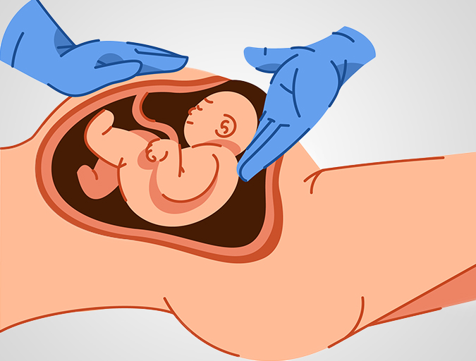 Best Hospital for Cesarean Delivery in Lucknow India