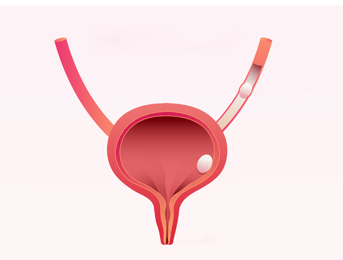 Bladder Stone Treatment in Lucknow, India
