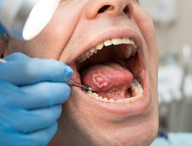 Oral Cancer Treatment in Lucknow