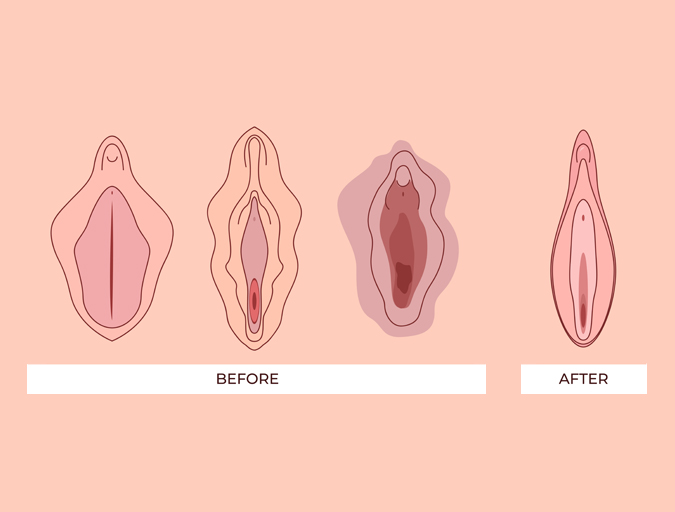 Best Hospital for Labiaplasty in Lucknow India