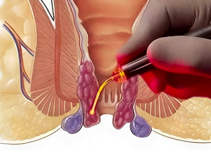 Laser anorectal surgery in Lucknow India