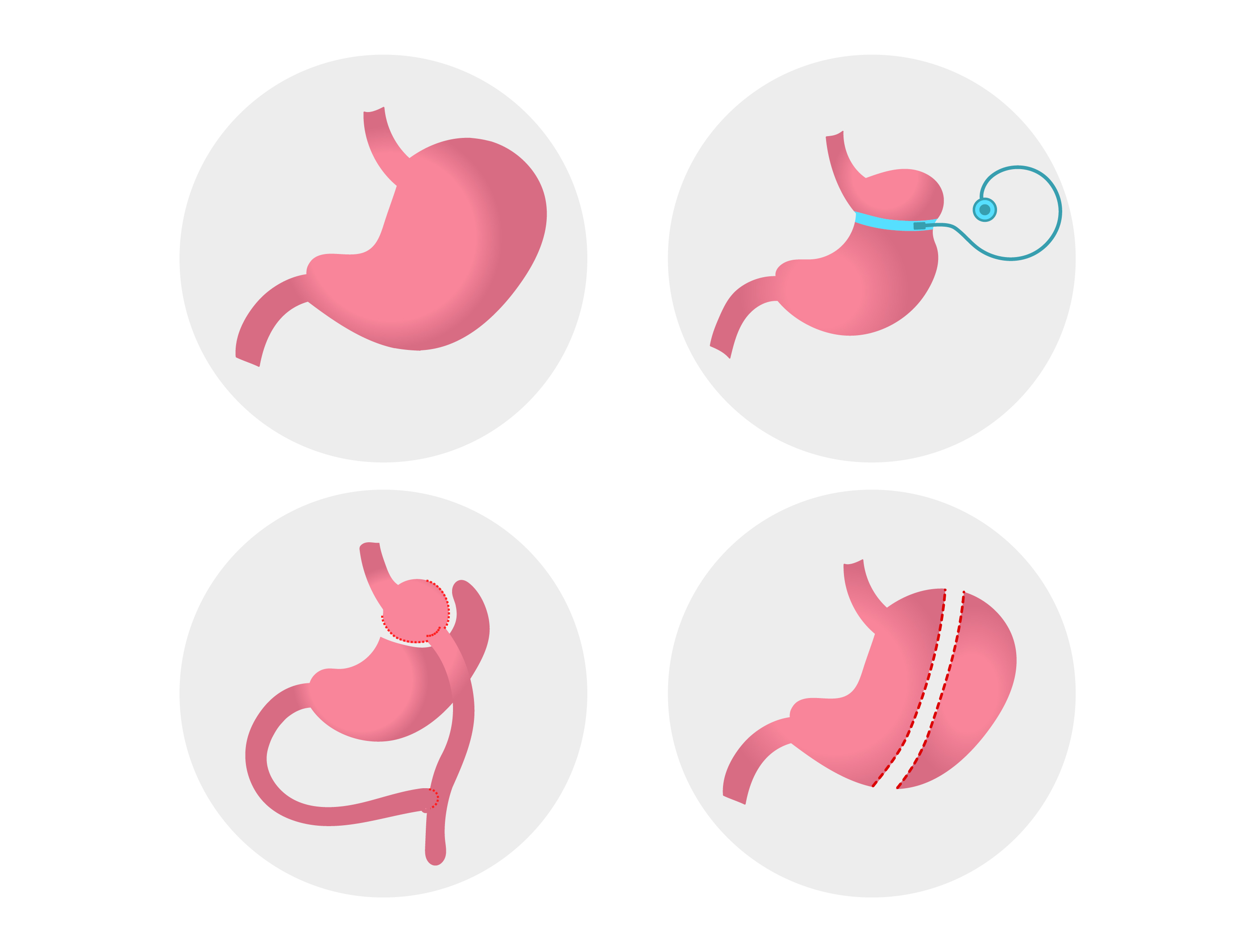 Bariatric Surgery in Lucknow India