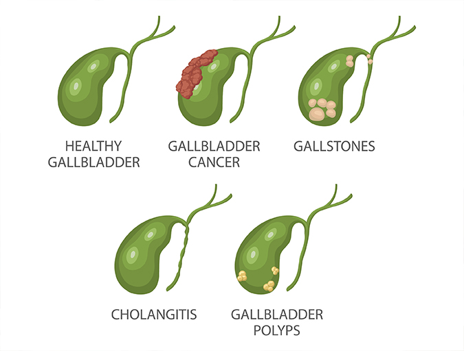 Gallbladder Surgery in Lucknow India