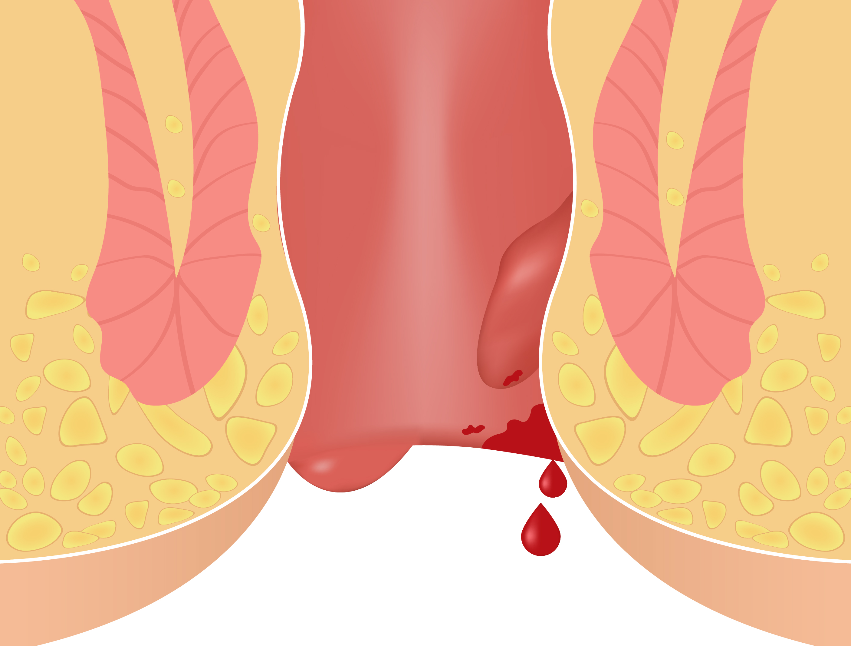 Hemmorrhoids Piles Treatment in Lucknow India
