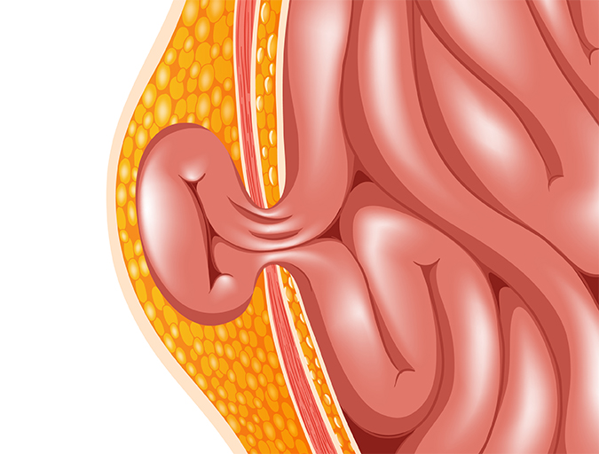 Hernia Treatment in Lucknow India