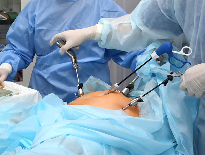 Minimally Invasive General Surgery in Lucknow India