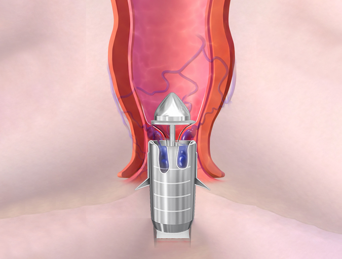 Best Hospital for Stapler Hemorrhoidectomy in Lucknow India