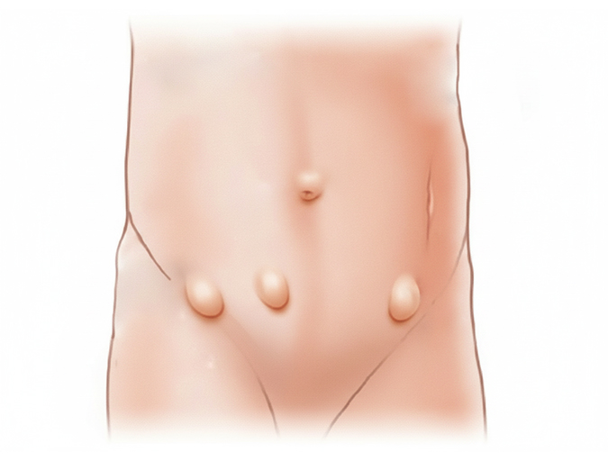 Types of Hernia Types of Hernia