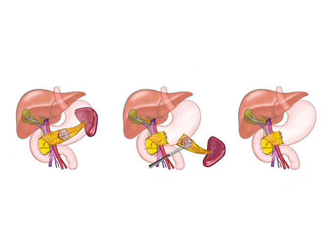 Distal Pancreatectomy in Lucknow India