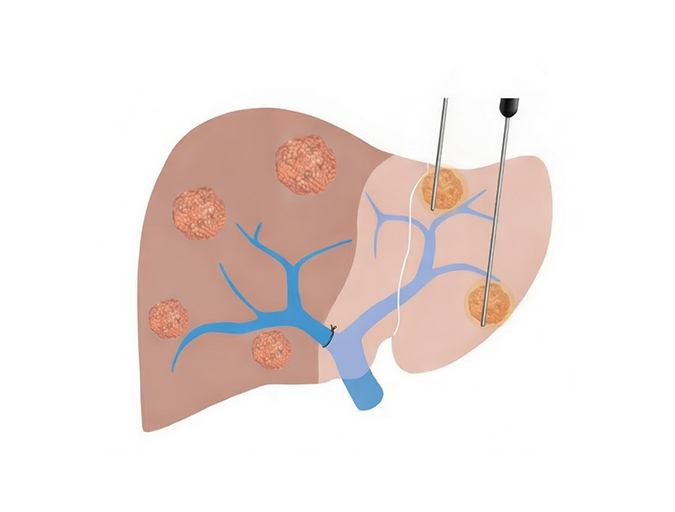 Microwave Ablation (MWA) in Lucknow India