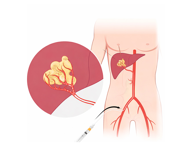 Transarterial Chemoembolization in Lucknow India