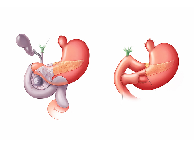 Whipple Procedure (Pancreaticoduodenectomy) in Lucknow India