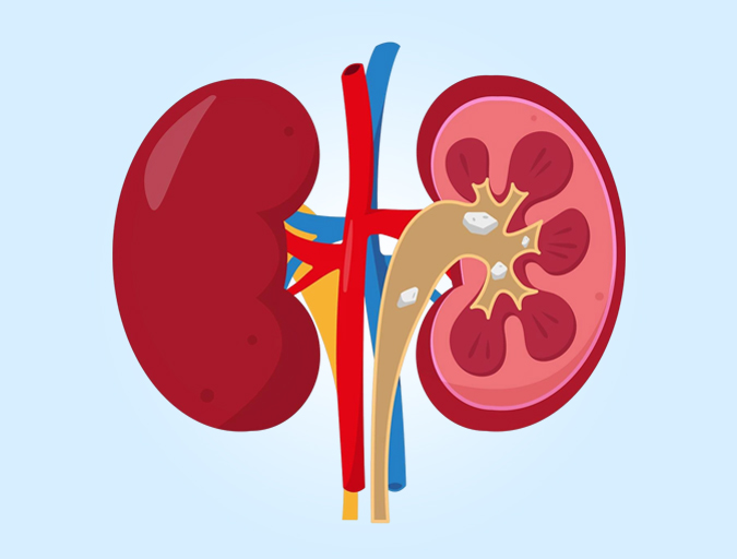 Kidney Stone Treatment Hospital in Lucknow