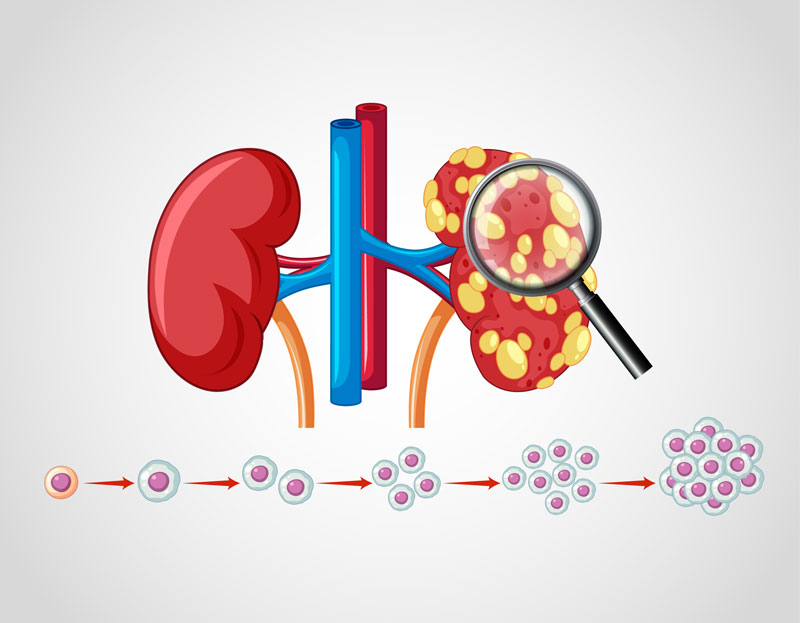 Renal Genetics Kidney Disease Treatment in Lucknow