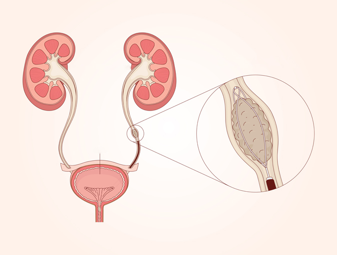 urethral stone Treatment in Lucknow, India